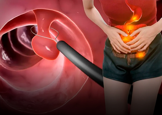Pólipos en el colon: síntomas, causas y cuándo hay riesgo de cáncer