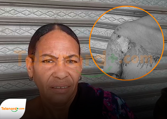 Mujer sufre graves quemaduras tras ser atacada con aceite caliente en Moca